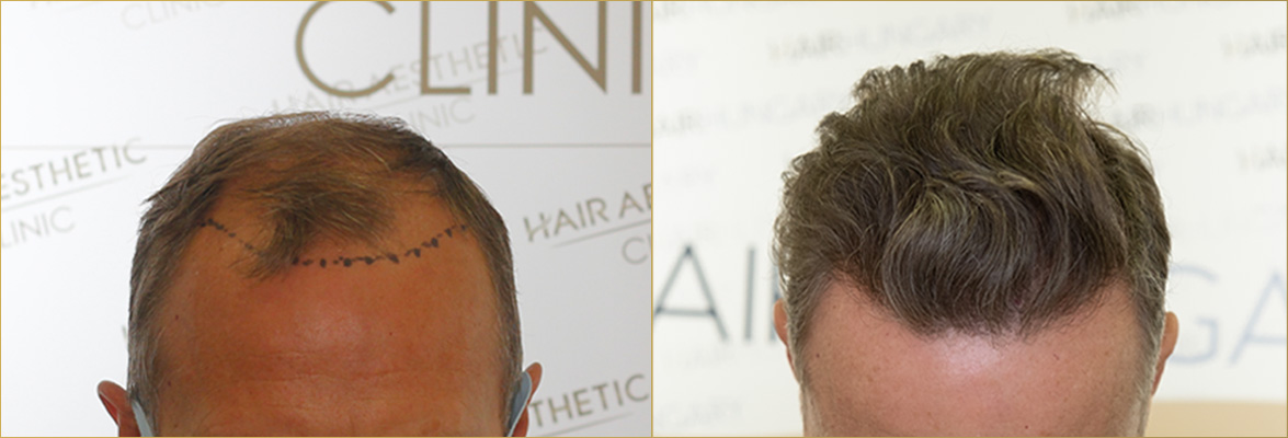 Hair transplantation result