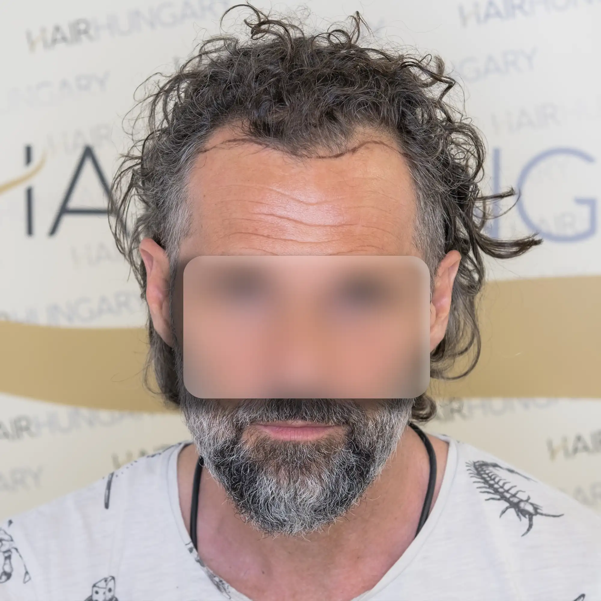 Trivellini FUE hajbeültetés előtti állapot szemből, a frontális hajterület és a hajvonal látható ritkulásával.
