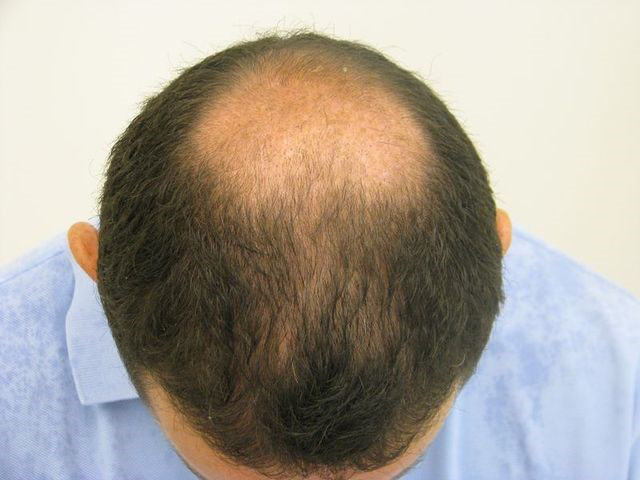 Krisztián Lisztes before the hair transplant
