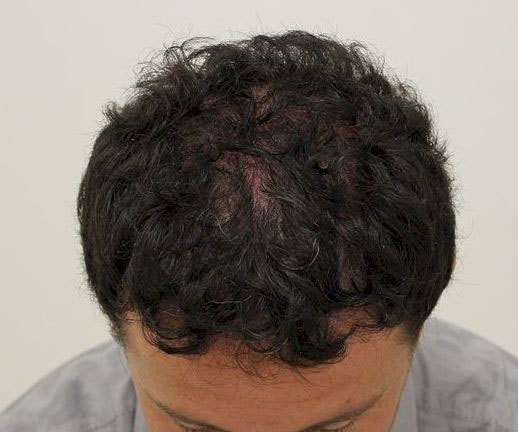 Krisztián Lisztes one year after the hair transplant