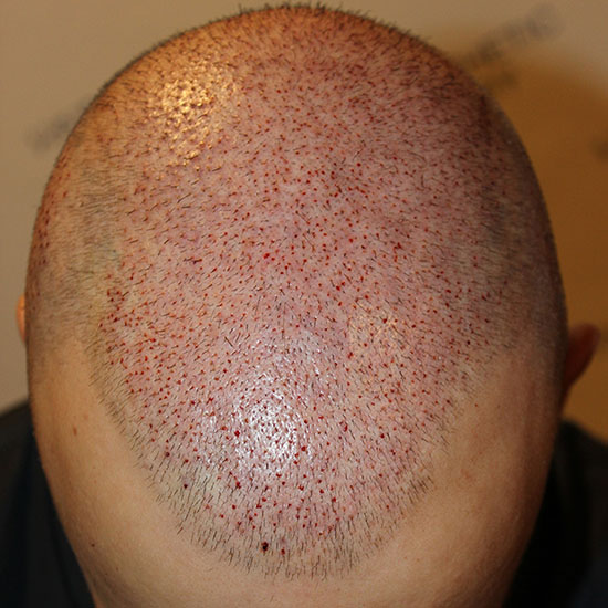 1 day after a hair transplant