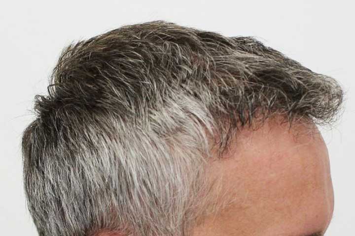 Rigenera Activa terápia után