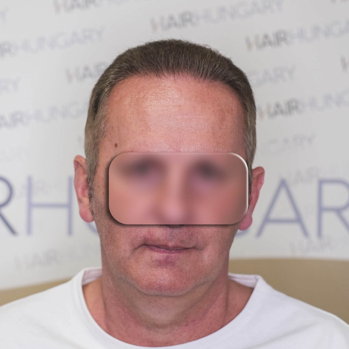 A Trivellini FUE hajbeültetés 6 hónapos eredménye szemből, kialakított hajvonallal és sűrűbb frontális hajterülettel.
