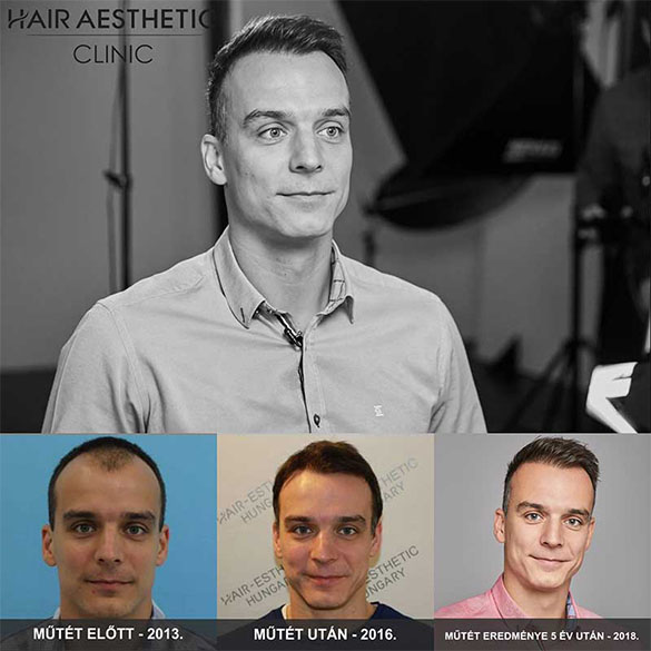 Haartransplantation von Gergely Harsányi